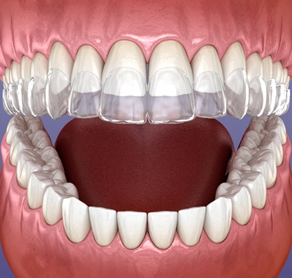 A clear aligner going on over the top row of teeth